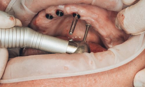 Implantologie dentaire Nice