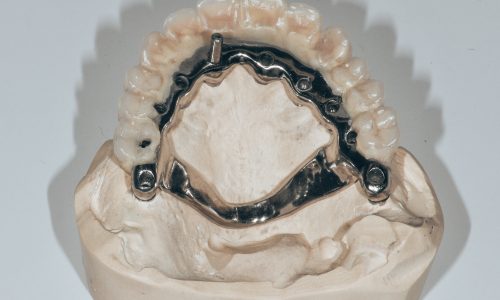 Implantologie dentaire Nice